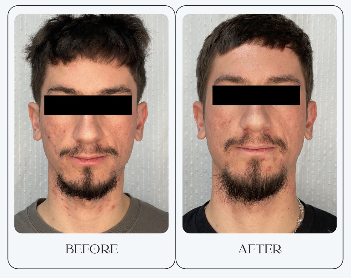 Understanding Acne and the Comprehensive Treatments We Offer